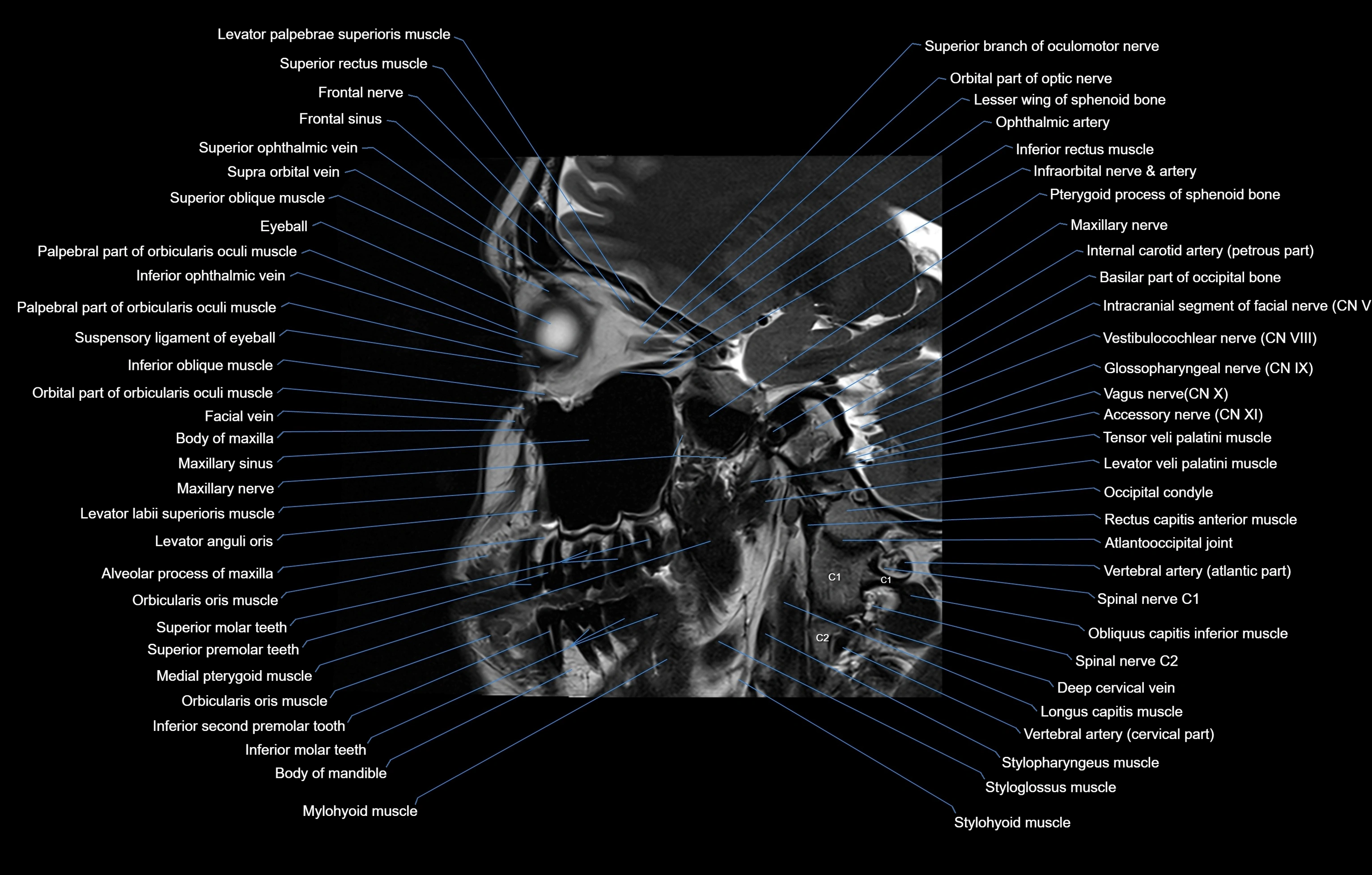 paranasal sinuses(PNS) MRI coronal  cross sectional anatomy 3T radiology  image-img-00001-00010.webp